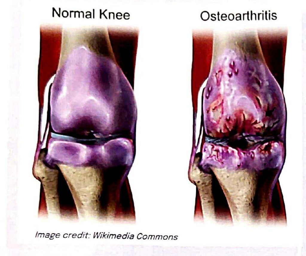 Normal Knee V/S Osteoarthritis